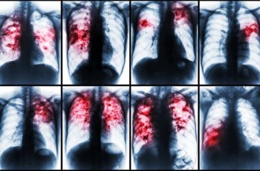 pulmones afectados por tuberculosis
