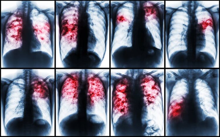 pulmones afectados por tuberculosis