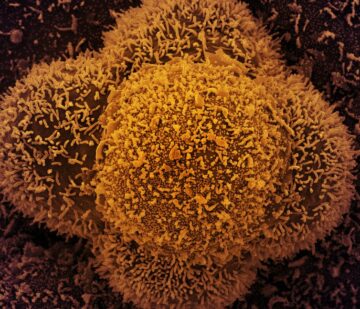 Células CCL-81 (células Vero utilizadas en investigación) fuertemente infectadas con partículas del virus SARS-CoV-2