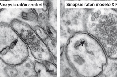 Sinapsis de un ratón control (izquierda) y sinapsis de un ratón modelo del síndrome del X Frágil (derecha). Se puede apreciar claramente que el ratón modelo del FXS presenta más vesículas sinápticas en contacto con la membrana presináptica