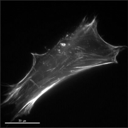 Célula derivada de un paciente con miopatía nemalínica con alteraciones en la formación de los filamentos de actina.