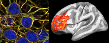 Panel izquierdo. Células neuronales humanas infectadas por una cepa de HSV-1. Panel derecho. Incremento de la concentración de beta amiloide cerebral en asociación con los niveles elevados de HSV-1.