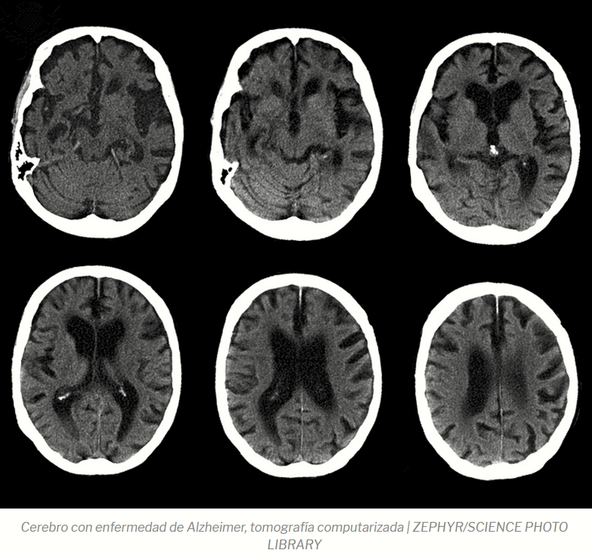 Cerebro Alzheimer